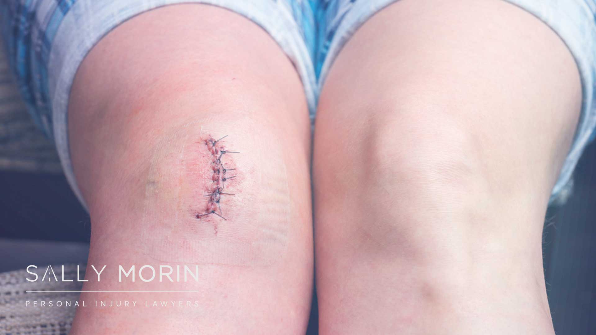 https://www.sallymorinlaw.com/wp-content/uploads/2023/09/Average-Settlement-for-Scarring-After-a-Car-Accident-Sally-Blog-Hero-1.jpg
